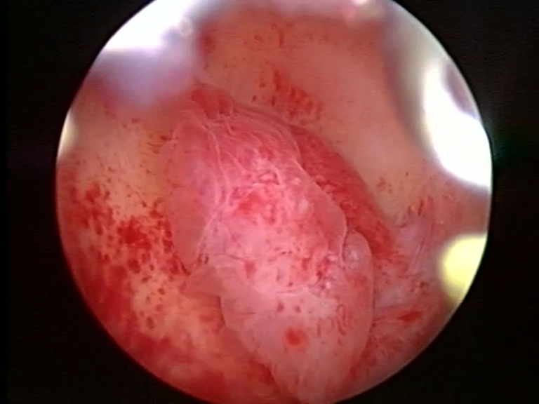 Ablazione endometriale: prima.