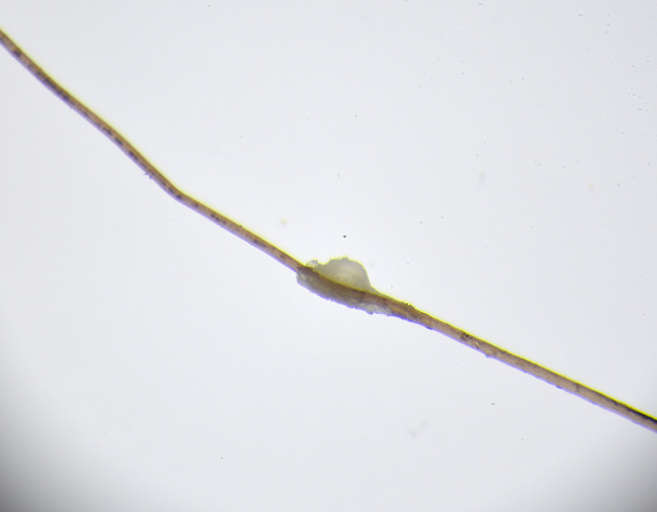 I.U.D. inserita correttamente, in cavità uterina, vista tramite ecografia trans-vaginale tridimensionale (notare l&apos;asse e i braccetti della spirale)