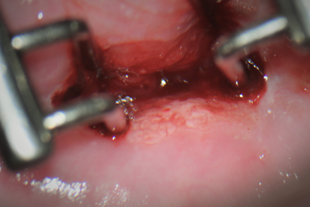 Ecografia T.V. 3D utero bicorne