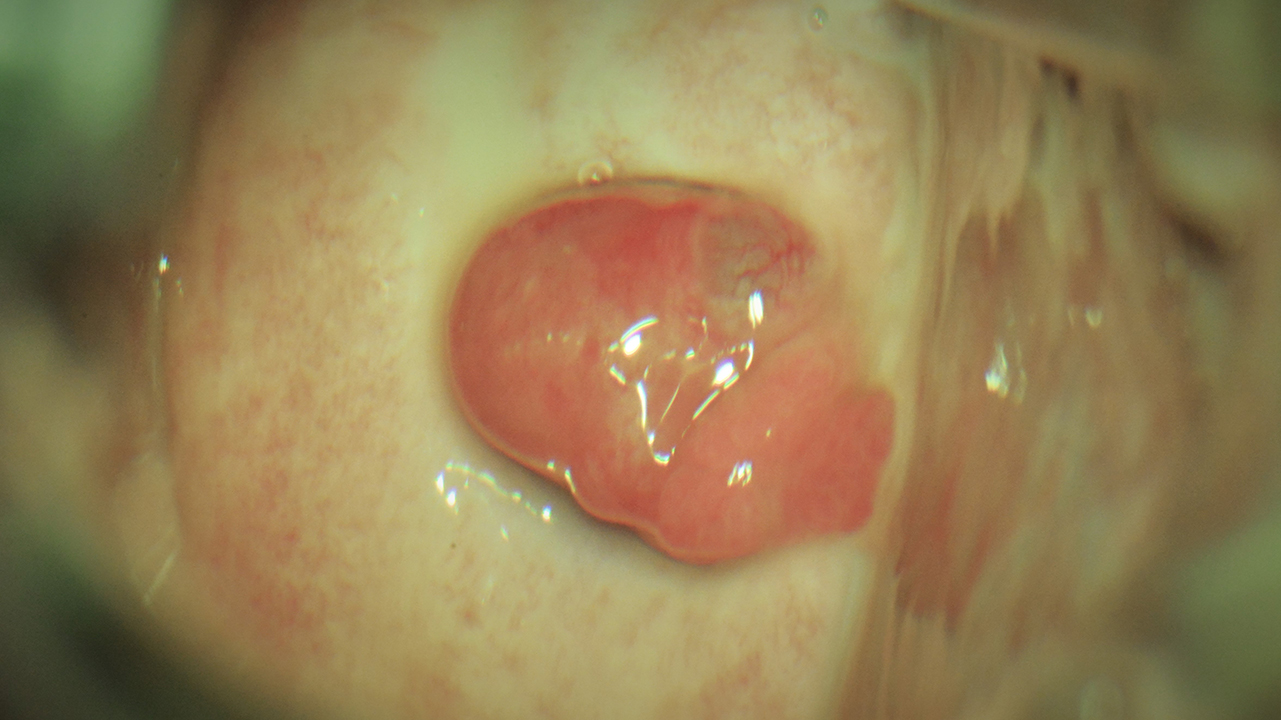 Ecografia T.V. 3D utero bicorne