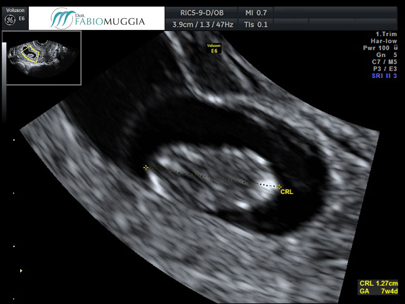 Ecografia T.V. 3D utero bicorne