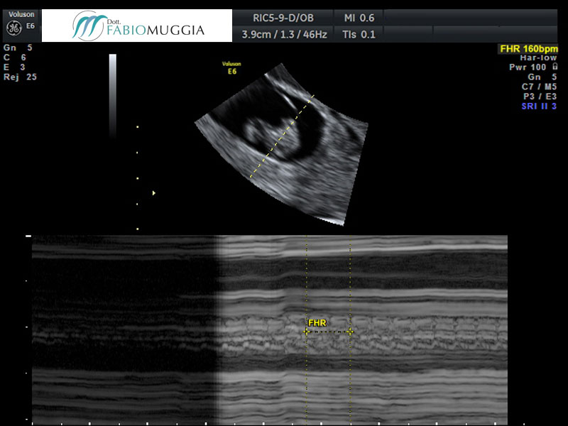 Ecografia T.V. 3D utero bicorne