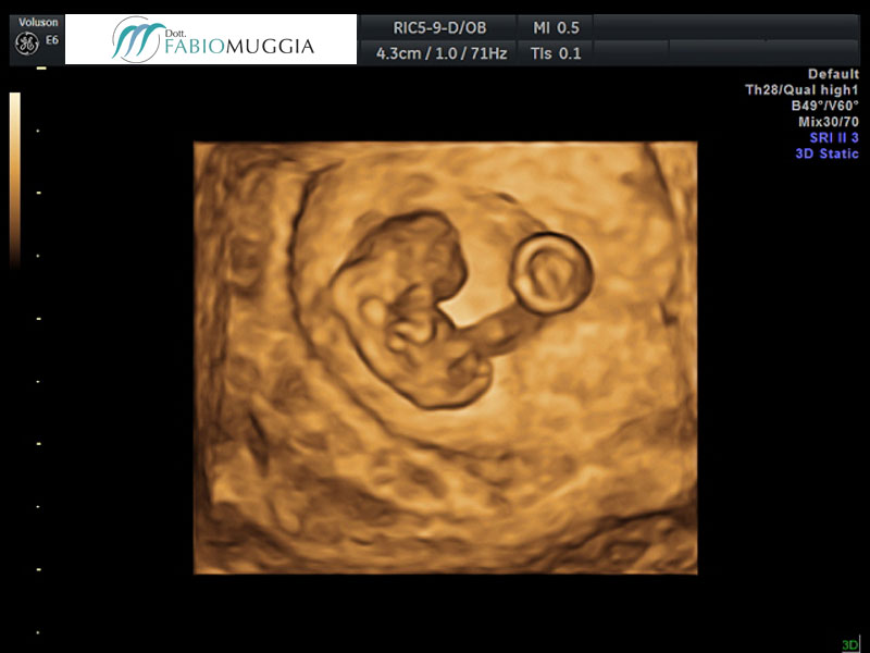 Ecografia T.V. 3D utero bicorne. Si noti che la separazione dell&apos;utero in due distinte cavità inizia ad essere evidente già al livello dell&apos;istmo.