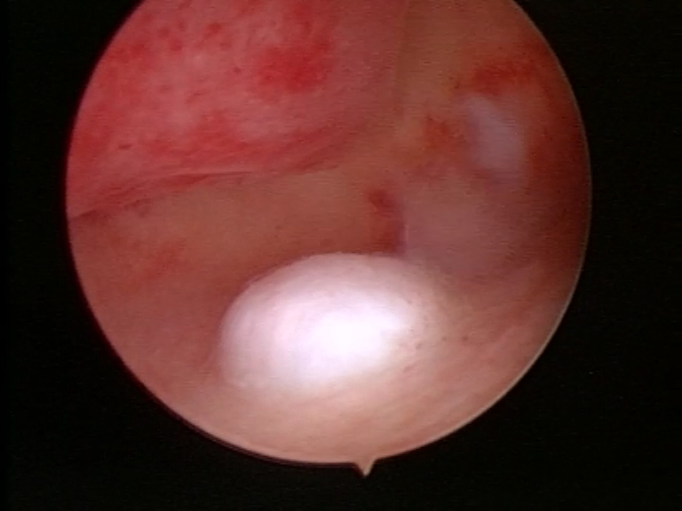 Fibroma sottomucoso.
