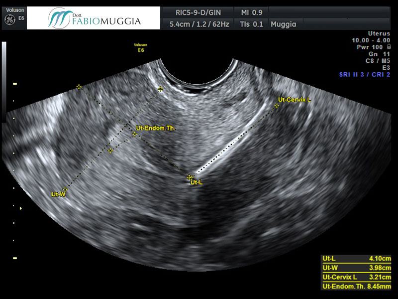 I.U.D. inserita erroneamente, al di fuori della cavità uterina, vista tramite ecografia trans-vaginale