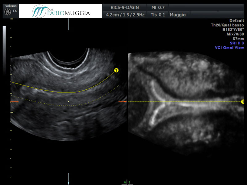 I.U.D. inserita correttamente, in cavità uterina, vista tramite ecografia trans-vaginale tridimensionale (notare l&apos;asse e i braccetti della spirale)