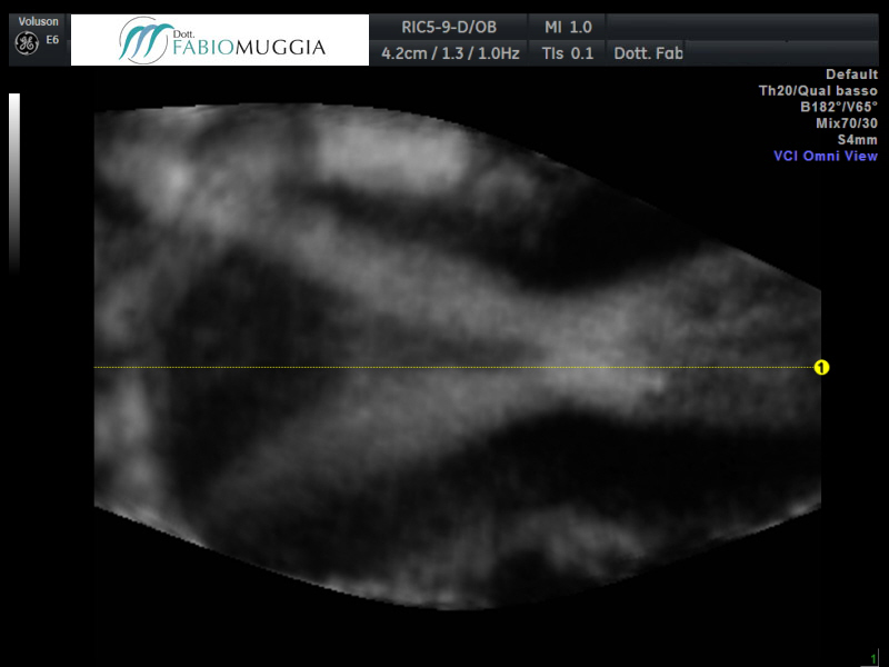 MR – Utero didelfoPARA 0.