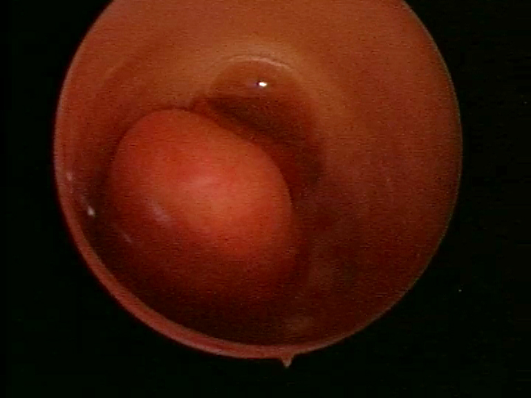 Polipo endometriale.