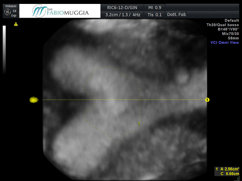 DAAMA – PARA 0. Utero bicorne - Dopo la «metroplastica».