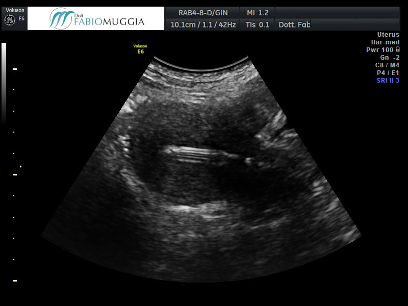 I.U.D. correttamente inserita in cavità uterina, vista tramite ecografia trans-addominale