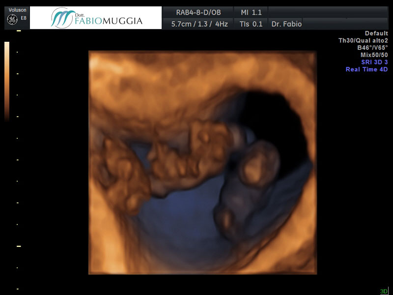 Ecografia T.V. 3D utero bicorne