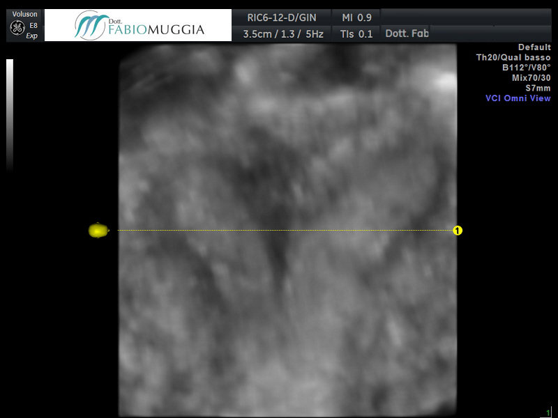 DAAMA – PARA 0. Utero bicorne - Prima.