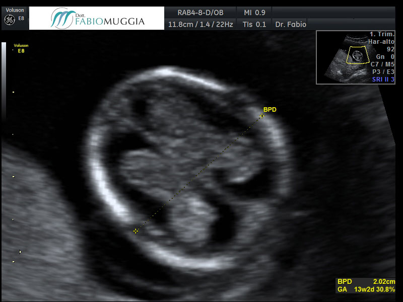Ecografia T.V. 3D utero bicorne