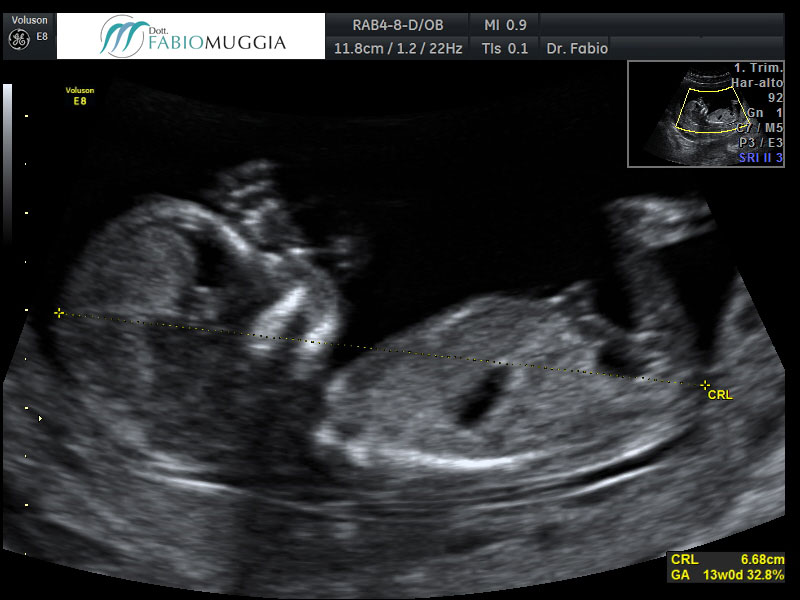Ecografia T.V. 3D utero bicorne