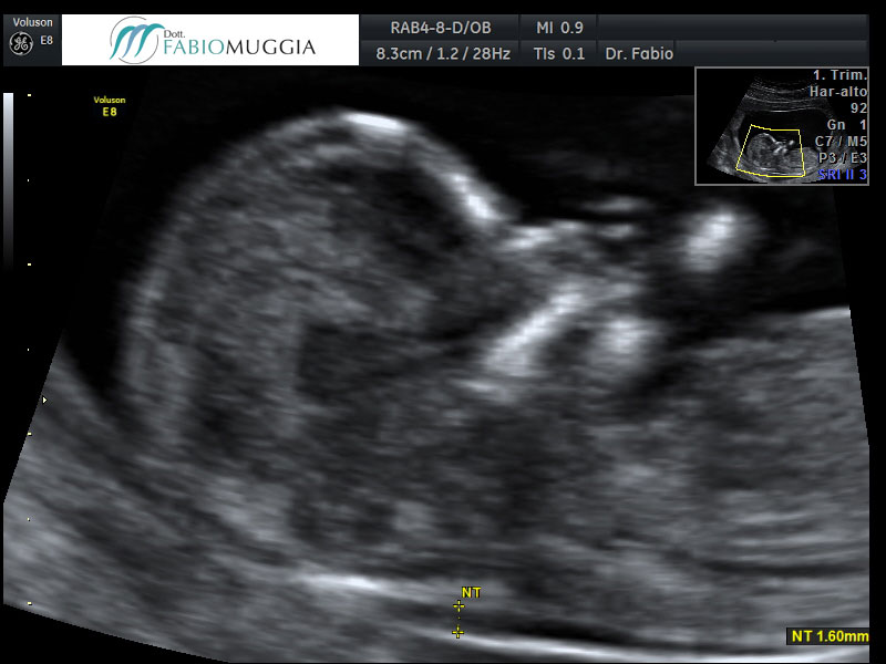 Ecografia T.V. 3D utero bicorne