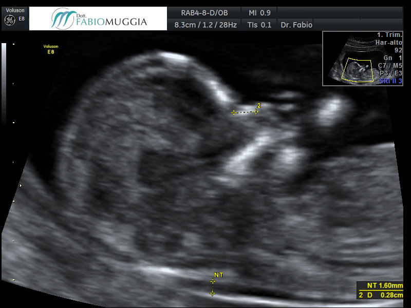 Ecografia T.V. 3D utero bicorne. Si noti che la separazione dell&apos;utero in due distinte cavità inizia ad essere evidente già al livello dell&apos;istmo.