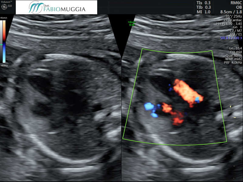 Immagini di cuore normale a 22 settimane.