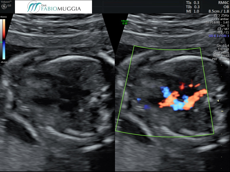 Immagini di cuore normale a 22 settimane.