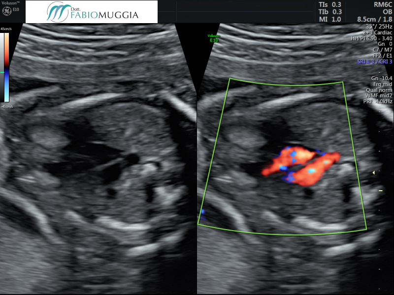 Immagini di cuore normale a 22 settimane.