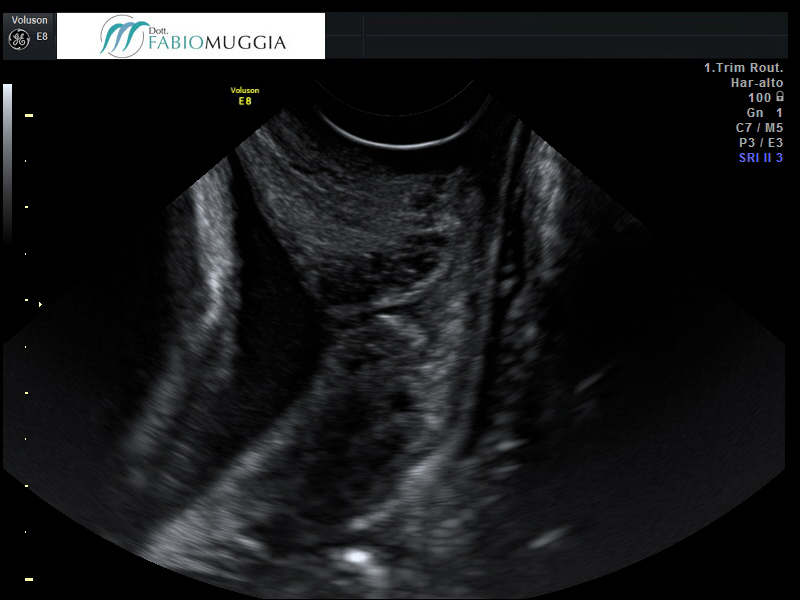 Tramite l’ecografia transvaginale si nota un marcato e netto «ampliamento» del tratto più interno del canale cervicale ed altrettanto evidente raccorciamento della «lunghezza funzionale residua».