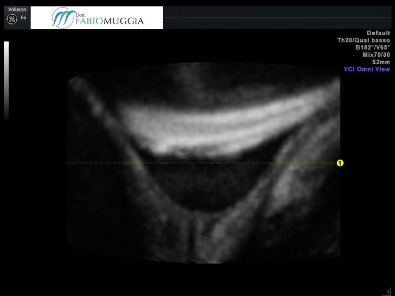 Si nota il vistoso «imbuto» che indica il «cedimento» della struttura dell’ orifizio uterino interno, il vero elemento di tenuta che permette al feto di rimanere in utero fino al termine della gestazione, fino all’inizio del travaglio di parto.