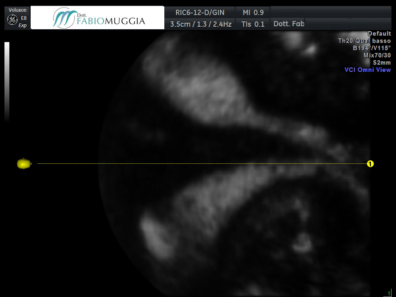CAL – Utero «didelfo» (doppio) PARA 0.